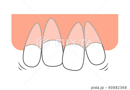ガタガタ歯並び 前歯矯正のイラスト素材 6068