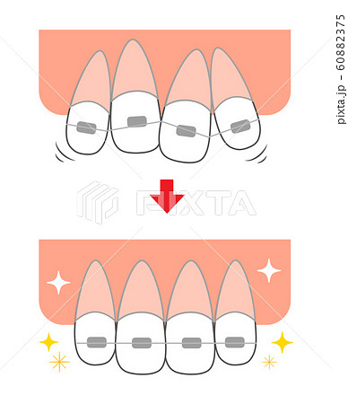 ガタガタ歯並びを矯正 前歯のイラスト素材 6075