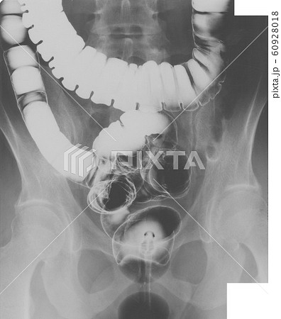 大腸レントゲン写真03 大腸レントゲン写真03 60928018