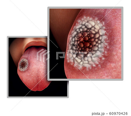 Tongue Cancer 60970426