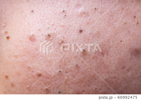 Ugly pimples blackheads on face of teenager 60992475