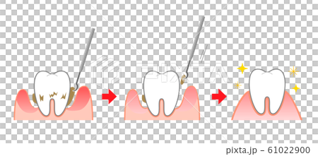 Periodontal disease scaling illustration before and after 61022900