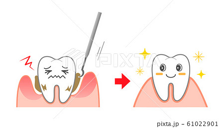 歯周病スケーリング図説 キャラクター ビフォーアフターのイラスト素材