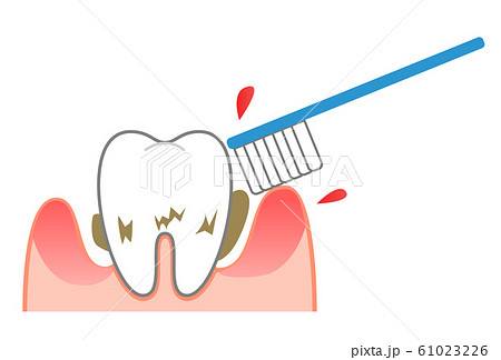 歯磨きと歯周ポケット出血のイラスト素材