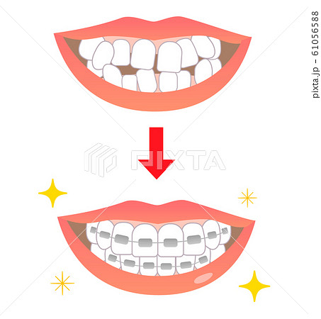 キラキラ矯正歯並びビフォーアフターのイラスト素材