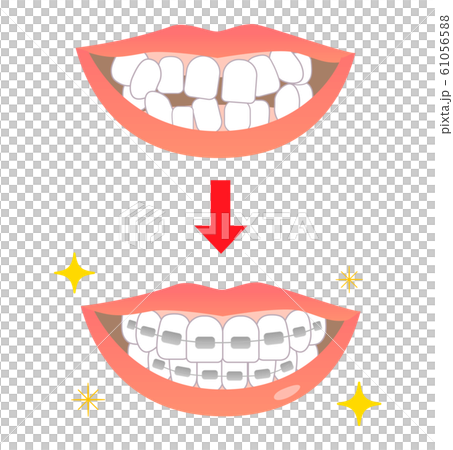 キラキラ矯正歯並びビフォーアフターのイラスト素材