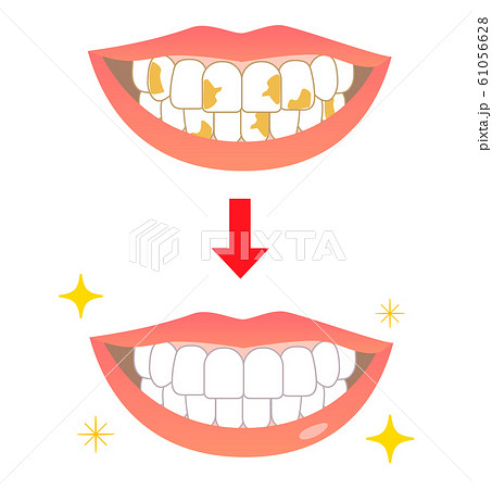 ホワイトニング黄ばみビフォーアフターのイラスト素材