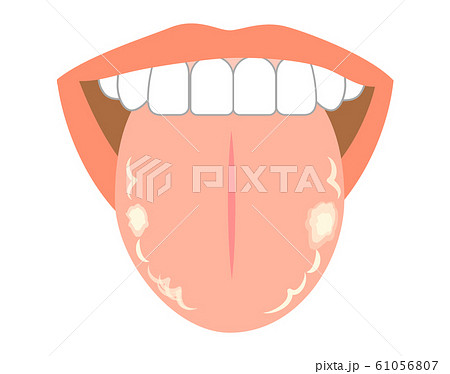 舌トラブル症状白い斑点できもののイラスト素材