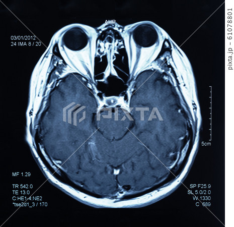 mri scan brain mri scan brain 61078801