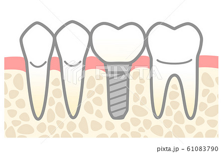 インプラント　図解 61083790