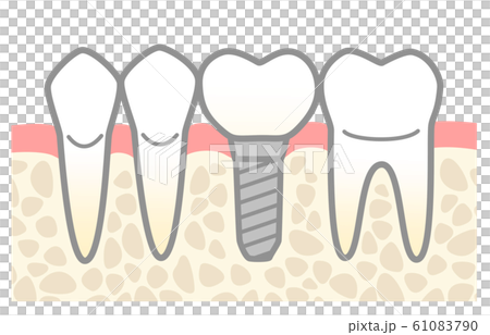 インプラント　図解 61083790