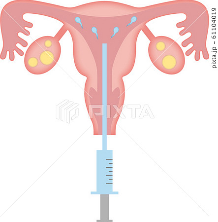 子宮_人工授精 61104019