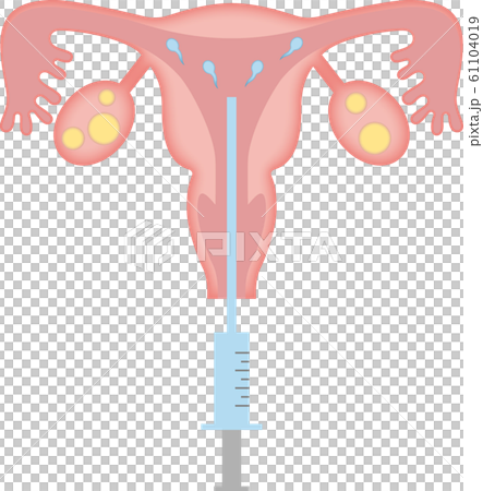 子宮_人工授精 61104019