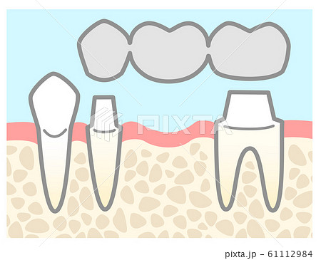 ブリッジ 銀歯 図解 支台の説明 背景色ありのイラスト素材