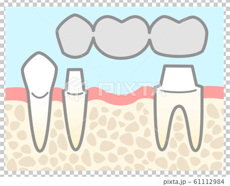 ブリッジ 銀歯 図解 支台の説明 背景色ありのイラスト素材