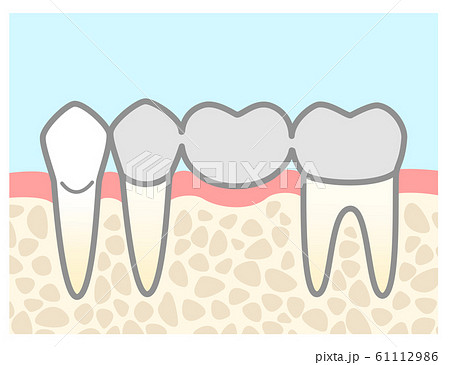 ブリッジ 銀歯 図解 背景色ありのイラスト素材