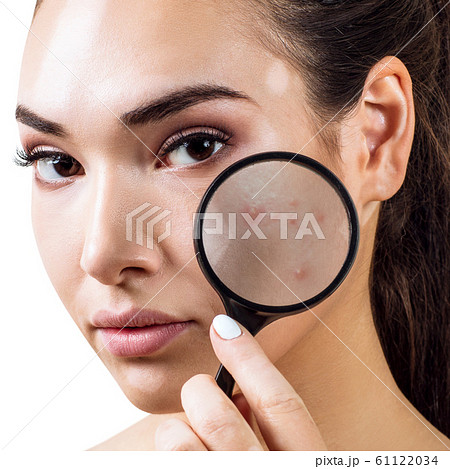Young woman with magnifying glass shows skin with acne. Young woman with magnifying glass shows skin with acne. 61122034