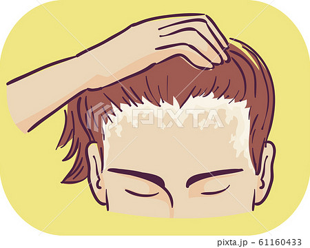 Man Symptom Scalp Scaly Patches Illustration 61160433