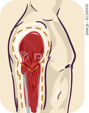 Man Muscle Atrophy Illustration Man Muscle Atrophy Illustration 61160440