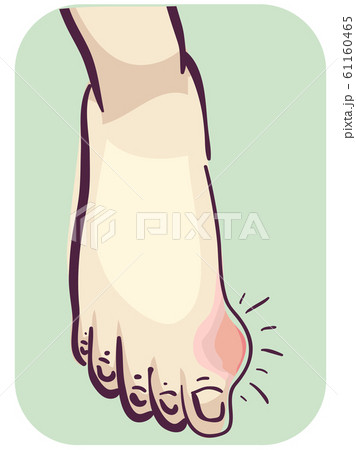 Foot with Gout 61160465