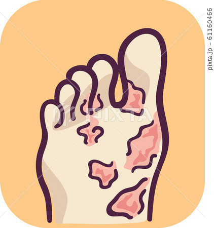 Foot Blisters Illustration Foot Blisters Illustration 61160466