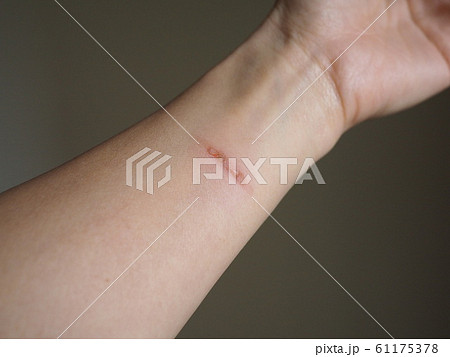 火傷した腕のクローズアップ写真、キッチンでフライパンによる火傷、 火傷した腕のクローズアップ写真、キッチンでフライパンによる火傷、 61175378