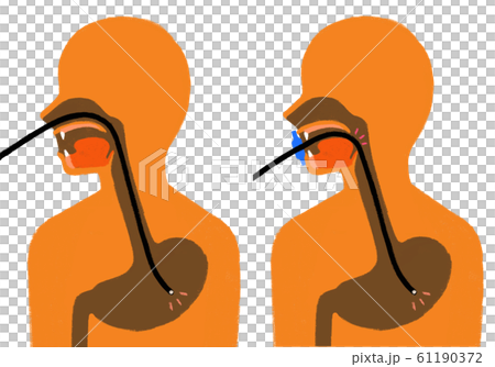 イラスト素材 胃カメラ検査 経鼻 経口のイラスト素材