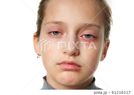Allergic reaction, skin rash, close view portrait 61216317