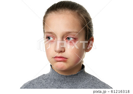 Allergic reaction, skin rash, close view portrait Allergic reaction, skin rash, close view portrait 61216318