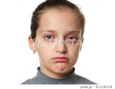 Allergic reaction, skin rash, close view portrait Allergic reaction, skin rash, close view portrait 61216319