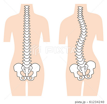 まっすぐな背骨 歪んだ背骨 脊椎側弯症のイラスト素材