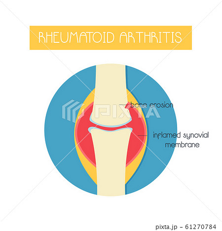 Illustration of a bone with rheumatoid arthritis. 61270784