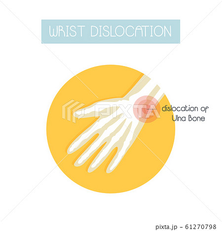 Illustration in a flat style of wrist dislocation. Illustration in a flat style of wrist dislocation. 61270798