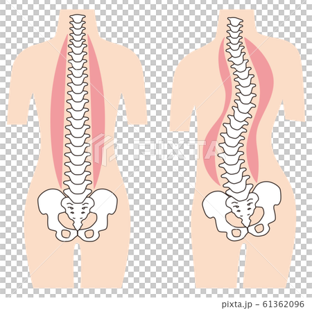 まっすぐな背骨 歪んだ背骨 脊椎側弯症 まっすぐな背骨 歪んだ背骨 脊椎側弯症 61362096