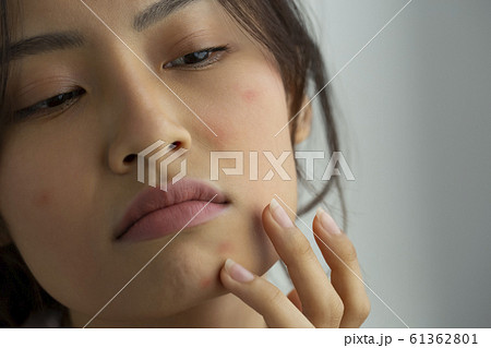 肌荒れに悩む女性 61362801