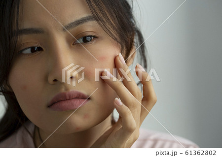 肌荒れに悩む女性 肌荒れに悩む女性 61362802