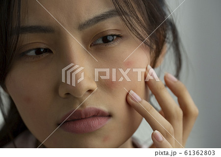 肌荒れに悩む女性 61362803