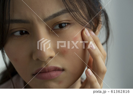 肌荒れに悩む女性 61362816