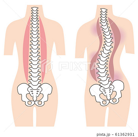 まっすぐな背骨 歪んだ背骨 脊椎側弯症 まっすぐな背骨 歪んだ背骨 脊椎側弯症 61362931