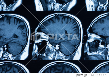 brain ct scan brain ct scan 61364337