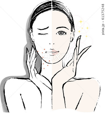 女性　大人ニキビ　ビフォーアフター 61375248