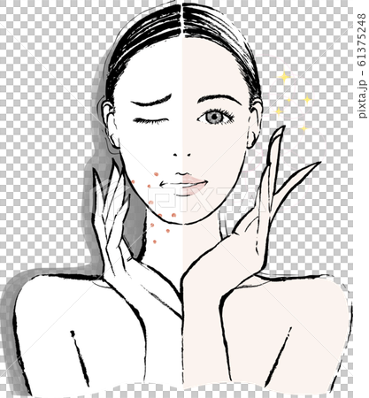 女性　大人ニキビ　ビフォーアフター 61375248