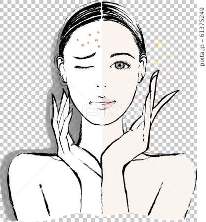 おでこのニキビ　ビフォーアフター 61375249