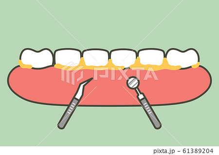 teeth scaling, dental plaque removal for cleaning 61389204