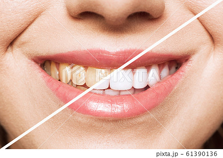 woman teeth before and after whitening. Over white background. Dental clinic patient. Image symbolizes oral care dentistry, stomatology 61390136