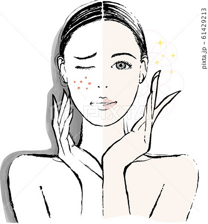 女性　頰の肌荒れ　ビフォーアフター 61429213