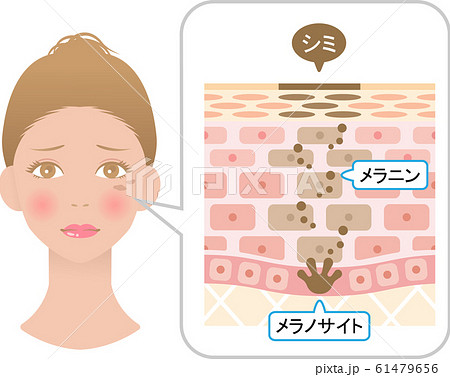 しみ女性 肌構造 しみ女性 肌構造 61479656