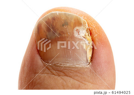 爪水虫の足親指 爪水虫の足親指 61494025