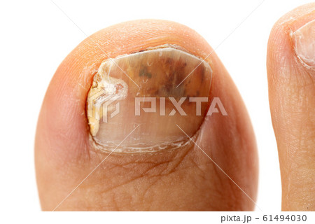 爪水虫 61494030