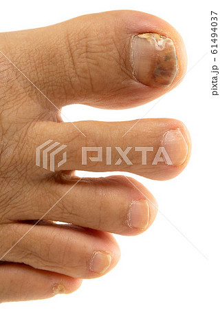 爪水虫 61494037